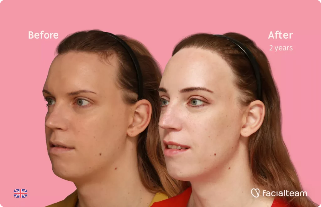 45 degree left angle image of FFS patient Emily showing the results before and after facial feminization surgery with Facialteam consisting of forehead feminization with hair transplant.