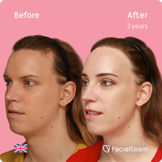 Square 45 degree left angle image of FFS patient Emily showing the results before and after facial feminization surgery with Facialteam consisting of forehead feminization with hair transplant.