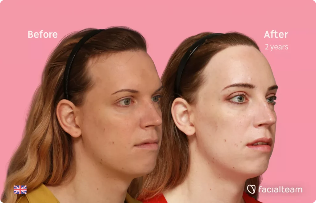 45 degree right angle image of FFS patient Emily showing the results before and after facial feminization surgery with Facialteam consisting of forehead feminization with hair transplant.