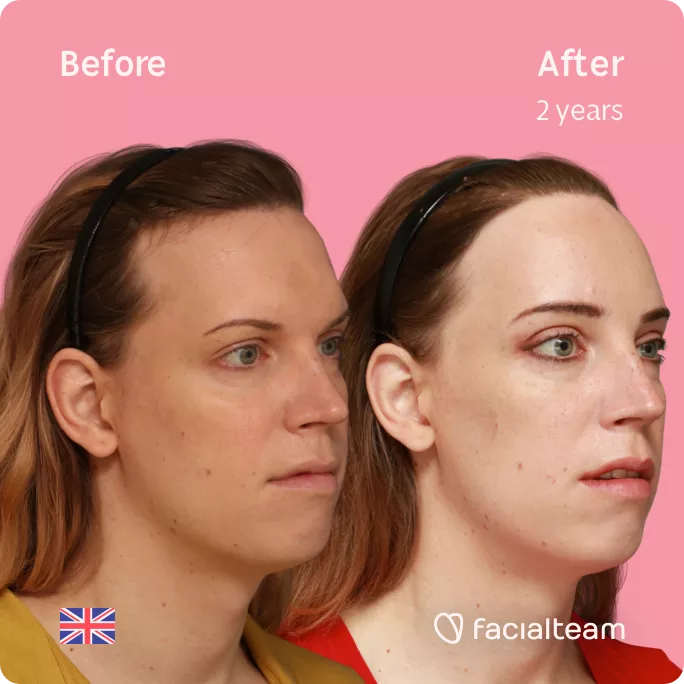Square 45 degree right angle image of FFS patient Emily showing the results before and after facial feminization surgery with Facialteam consisting of forehead feminization with hair transplant.