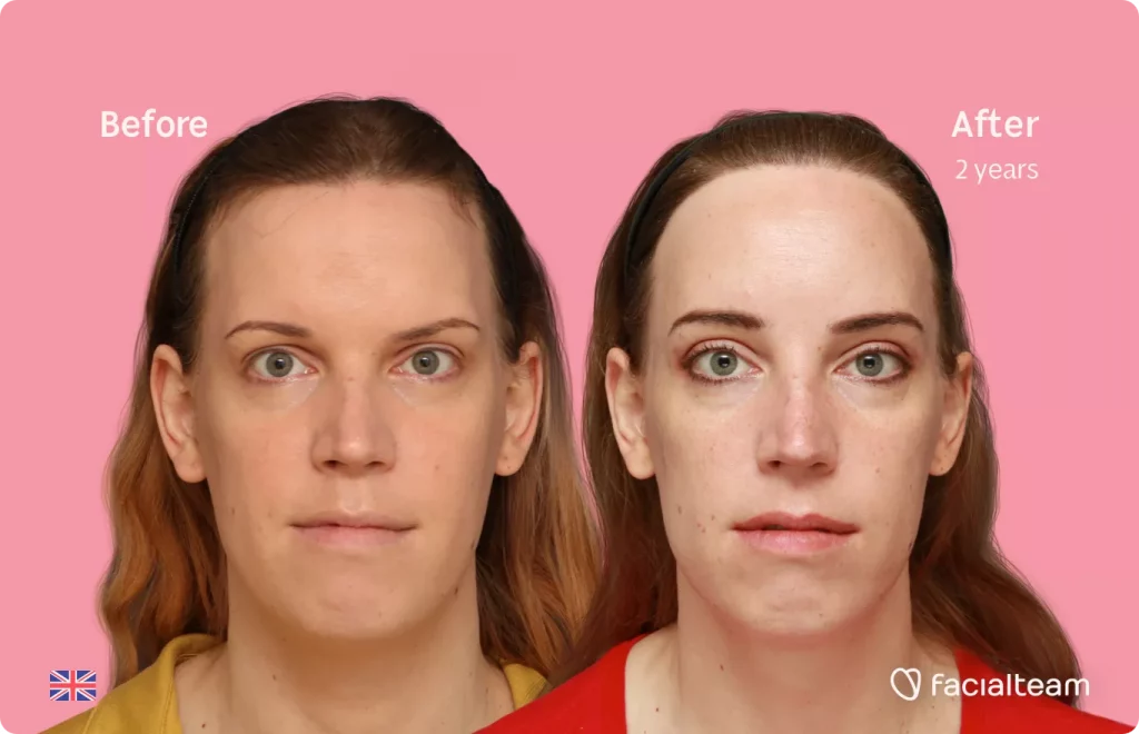 Frontal image of FFS patient Emily showing the results before and after facial feminization surgery with Facialteam consisting of forehead feminization with hair transplant.