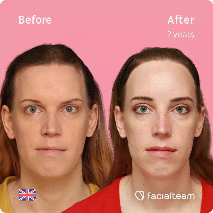 Square frontal image of FFS patient Emily showing the results before and after facial feminization surgery with Facialteam consisting of forehead feminization with hair transplant.