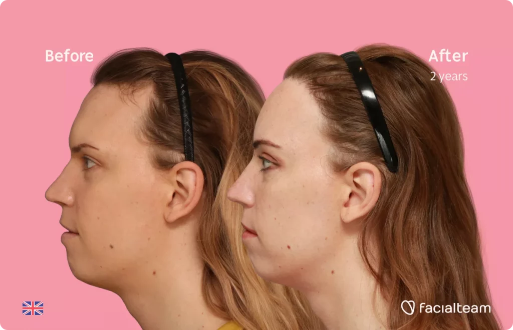 Side image of FFS patient Emily showing the results before and after facial feminization surgery with Facialteam consisting of forehead feminization with hair transplant.