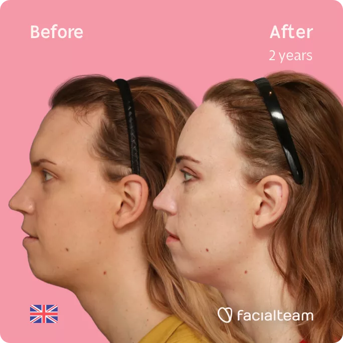 Square side image of FFS patient Emily showing the results before and after facial feminization surgery with Facialteam consisting of forehead feminization with hair transplant.