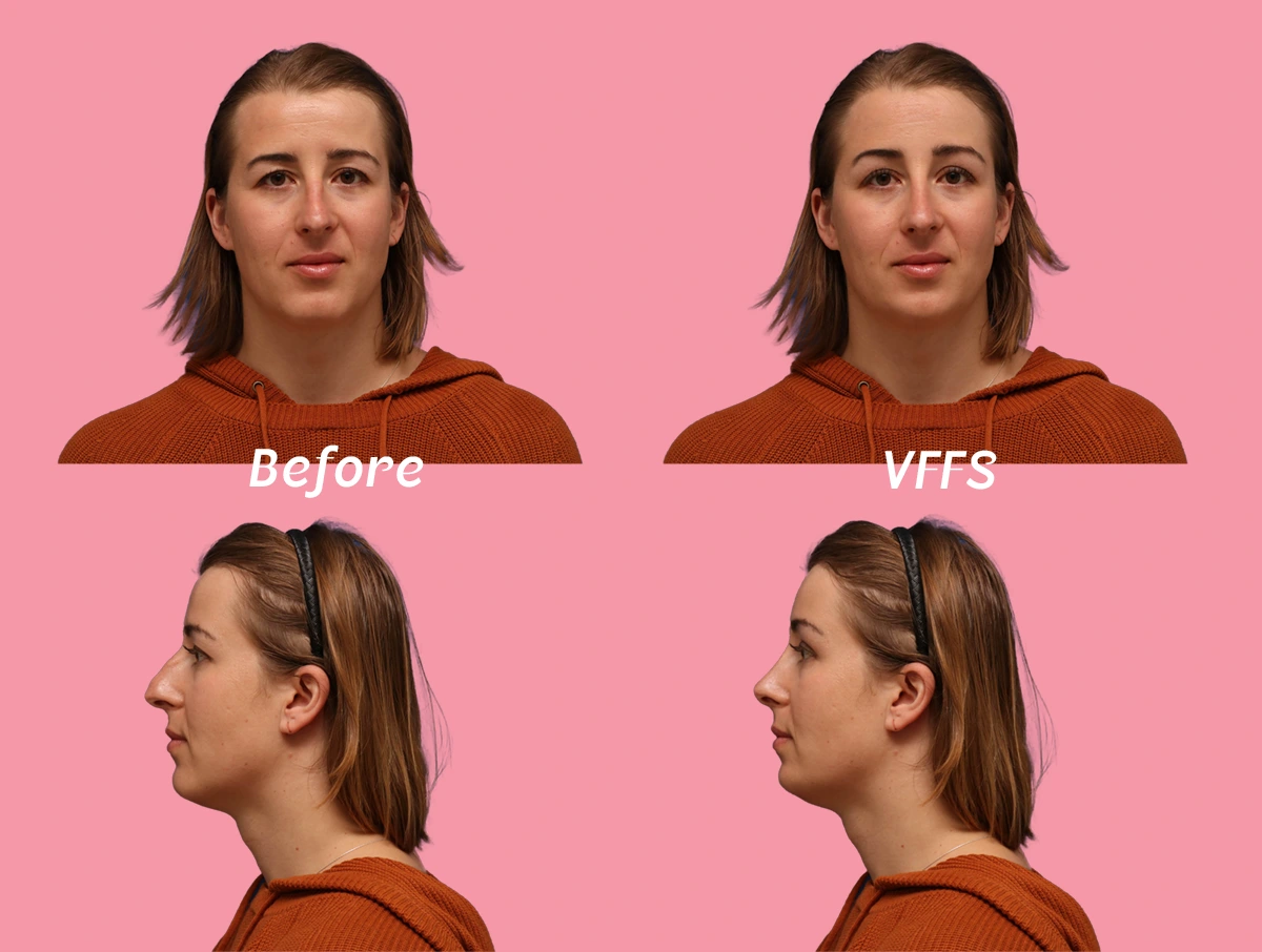 Example of a virtual ffs simulation. The image shows the frontal and profile images of a patients who Facialteam's virtual ffs expert made a simulation for.