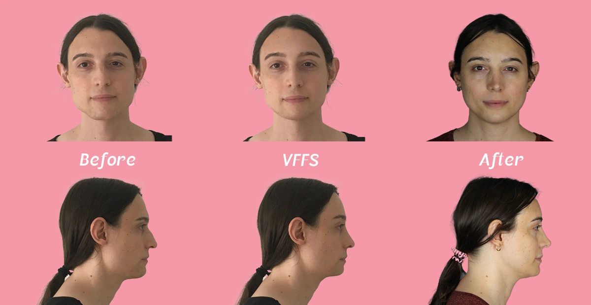Visual display of a virtual ffs simulation versus actual post surgical pictures. The image shows the frontal and profile images of patient Manu, who underwent facial feminization surgery with facialteam as well as a virtual ffs simulation, created by facialteam's virtual ffs expert.