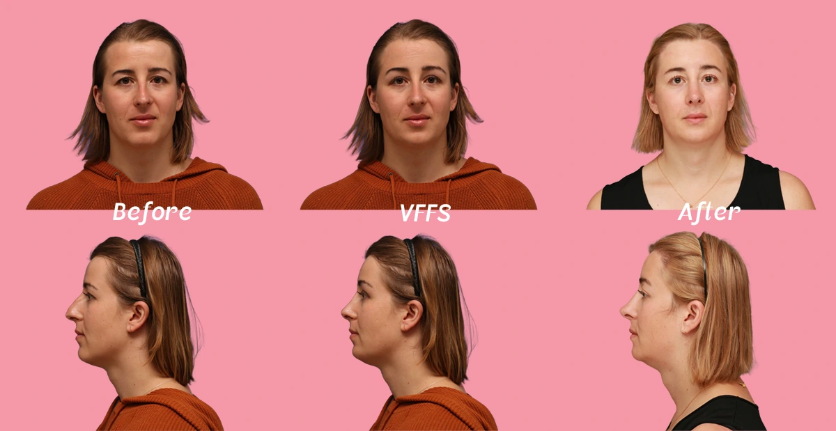 Visual display of a virtual ffs simulation versus actual post surgical pictures. The image shows the frontal and profile images of a patients that underwent facial feminization surgery with facialteam as well as a virtual ffs simulation, created by facialteam's virtual ffs expert.