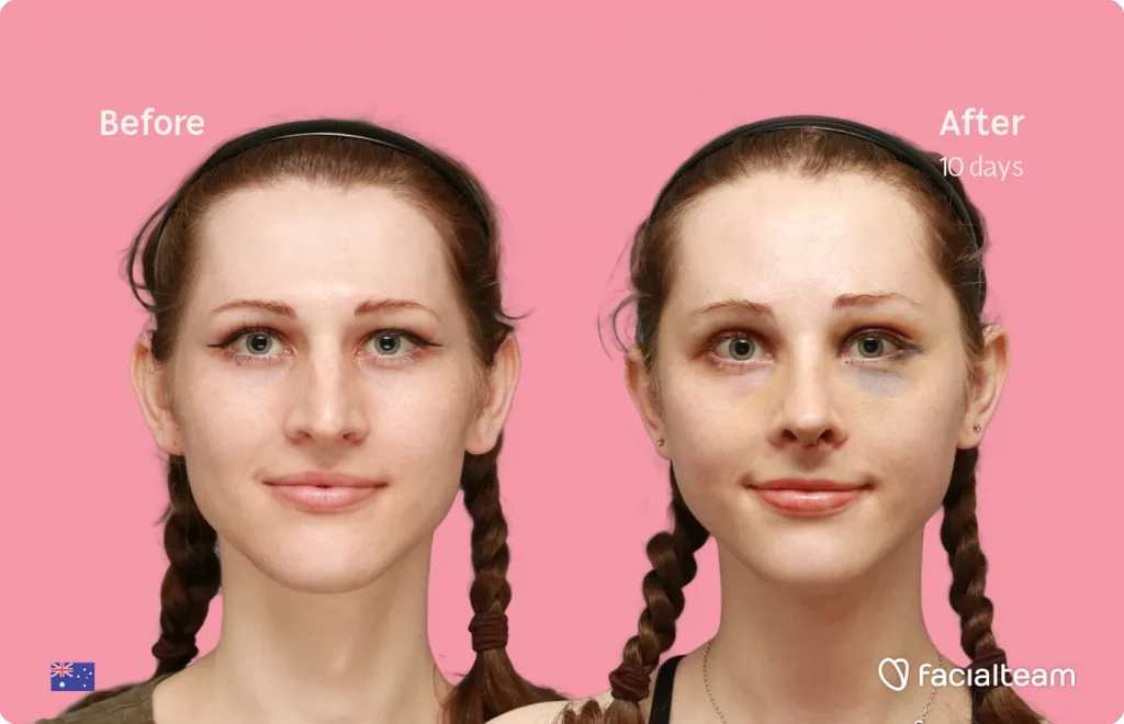 Frontal image of FFS patient Riley showing the results before and after facial feminization surgery with Facialteam consisting of forehead feminization, rhinoplasty and tracheal shave.