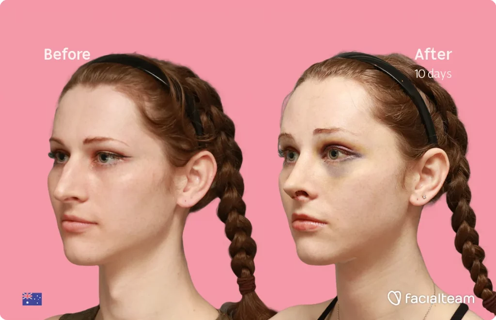 45 degree left angle image of FFS patient Riley showing the results before and after facial feminization surgery with Facialteam consisting of forehead feminization, rhinoplasty and tracheal shave.