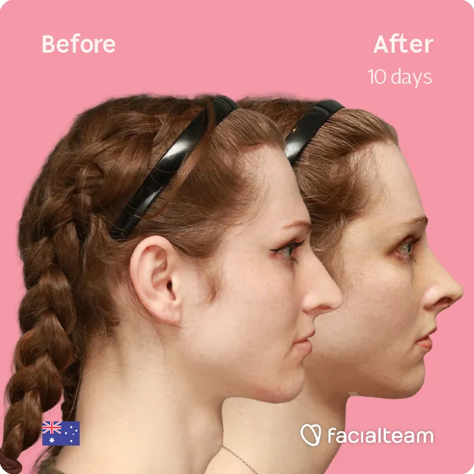 Square side image of FFS patient Riley showing the results before and after facial feminization surgery with Facialteam consisting of forehead feminization, rhinoplasty and tracheal shave.