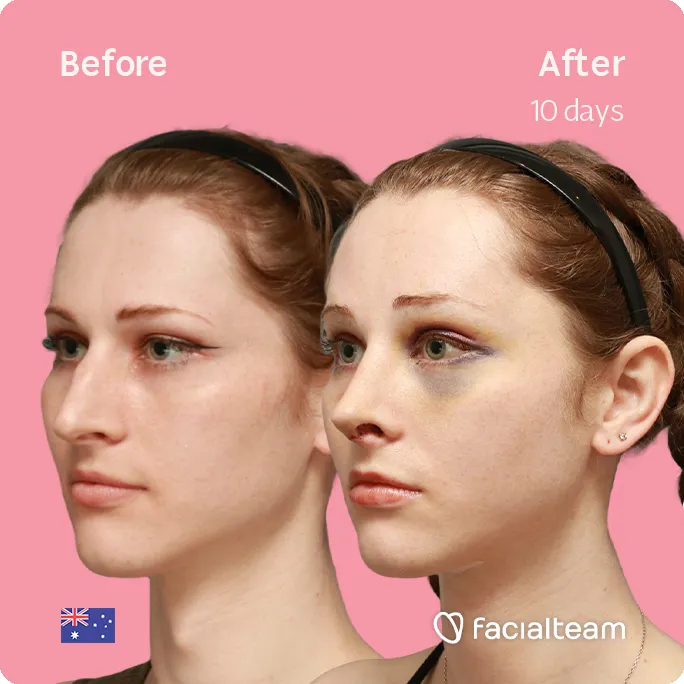Square 45 degree left angle image of FFS patient Riley showing the results before and after facial feminization surgery with Facialteam consisting of forehead feminization, rhinoplasty and tracheal shave.