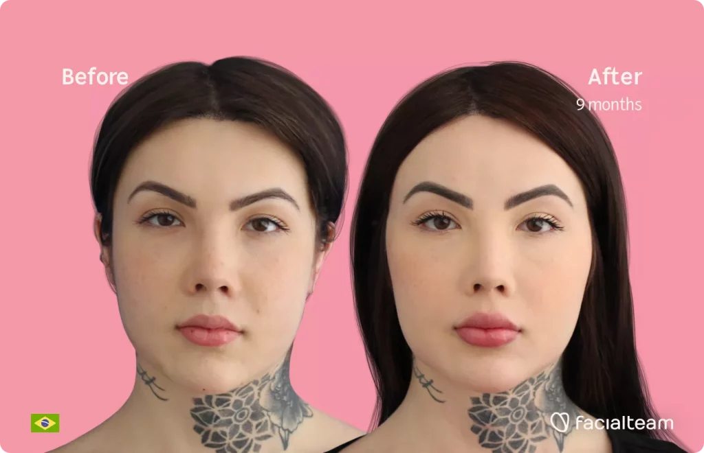 Frontal image of FFS patient Agatha showing the results before and after facial feminization surgery with Facialteam consisting of forehead feminization.