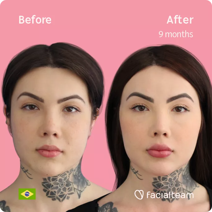 Square frontal image of FFS patient Agatha showing the results before and after facial feminization surgery with Facialteam consisting of forehead feminization.