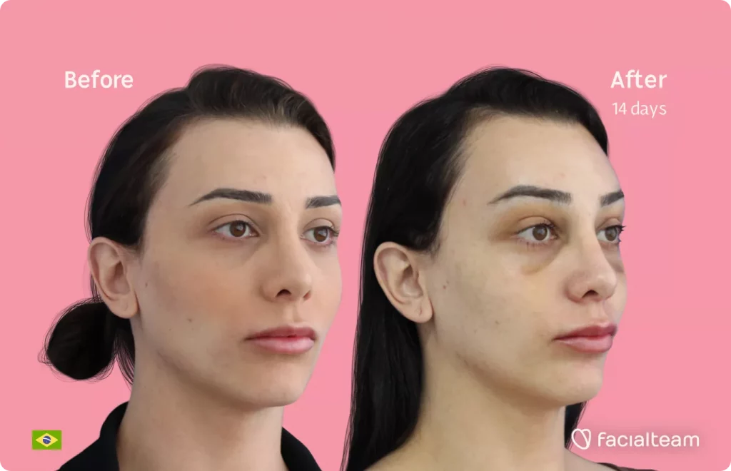 45 degree angle image of FFS patient Victoria M showing the results before and after facial feminization surgery with Facialteam consisting of forehead and chin feminization.