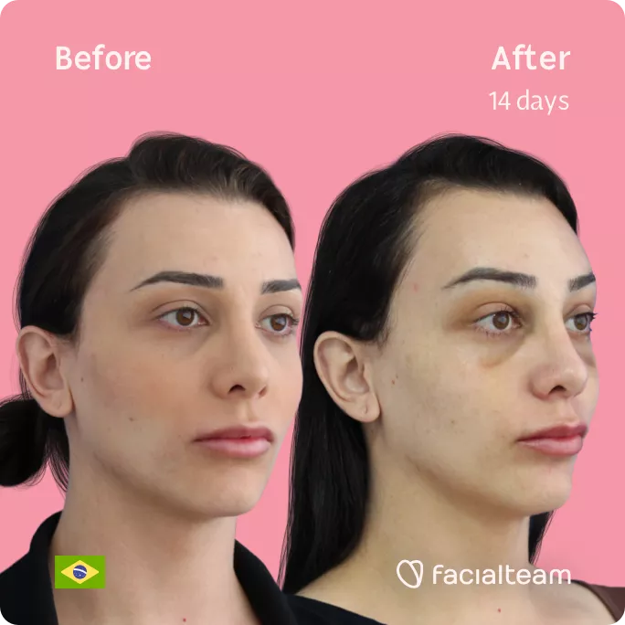 Square 45 degree angle image of FFS patient Victoria M showing the results before and after facial feminization surgery with Facialteam consisting of forehead and chin feminization.