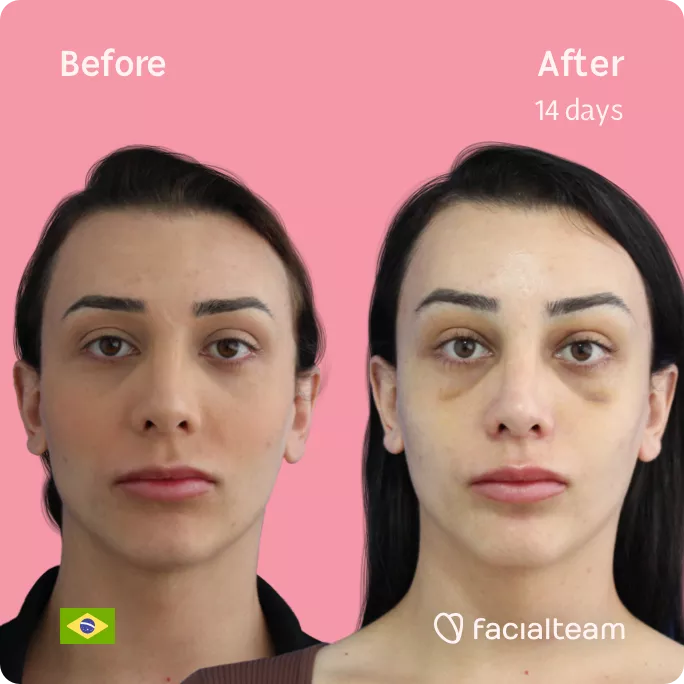 Square frontal image of FFS patient Victoria M showing the results before and after facial feminization surgery with Facialteam consisting of forehead and chin feminization.