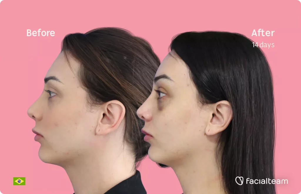 Side image of FFS patient Victoria M showing the results before and after facial feminization surgery with Facialteam consisting of forehead and chin feminization.