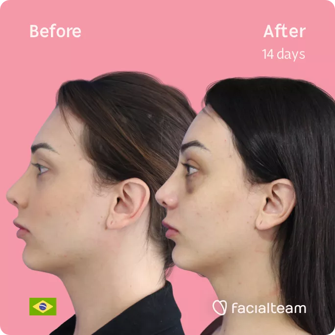 Square side image of FFS patient Victoria M showing the results before and after facial feminization surgery with Facialteam consisting of forehead and chin feminization.