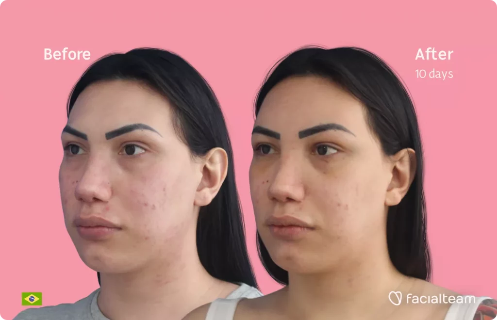 45 degree angle image of FFS patient Gabrielly showing the results before and after facial feminization surgery with Facialteam consisting of forehead feminization.