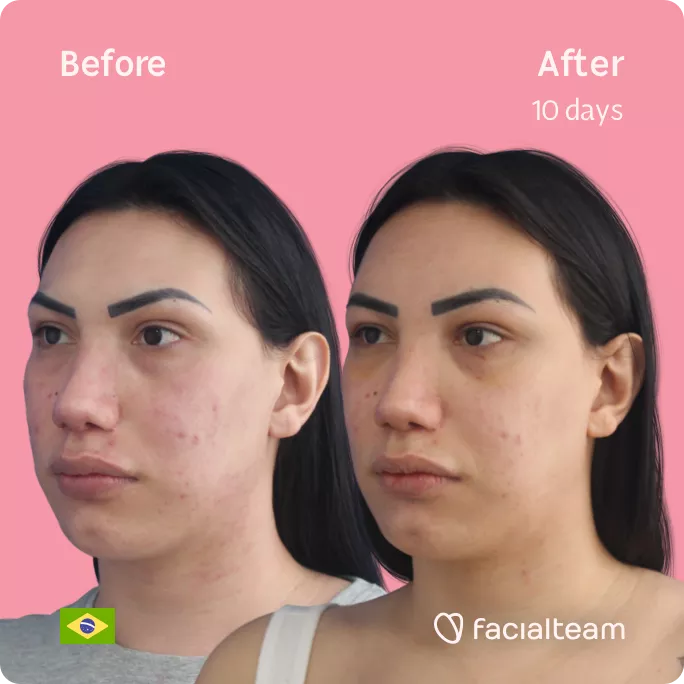 Square 45 degree angle image of FFS patient Gabrielly showing the results before and after facial feminization surgery with Facialteam consisting of forehead feminization.