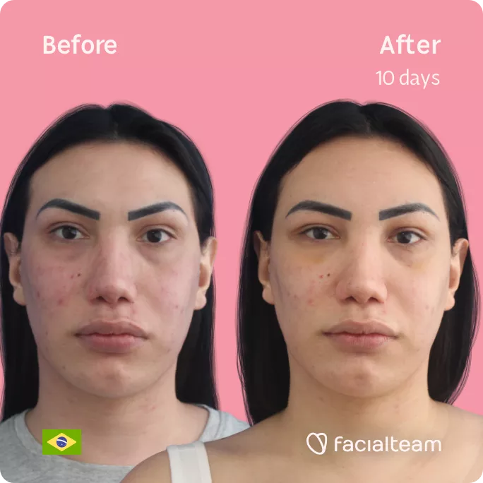 Square frontal image of FFS patient Gabrielly showing the results before and after facial feminization surgery with Facialteam consisting of forehead feminization.
