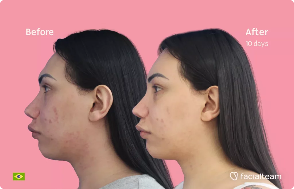 Side left image of FFS patient Gabrielly showing the results before and after facial feminization surgery with Facialteam consisting of forehead feminization.