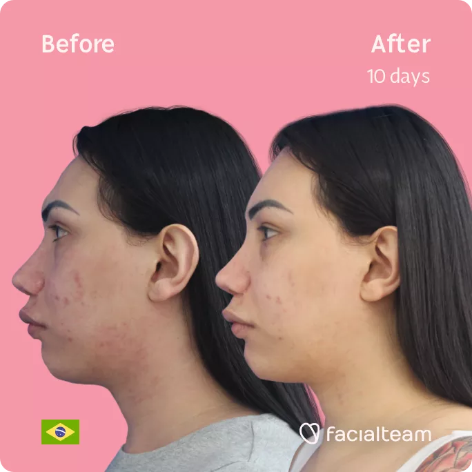 Square left side image of FFS patient Gabrielly showing the results before and after facial feminization surgery with Facialteam consisting of forehead feminization.