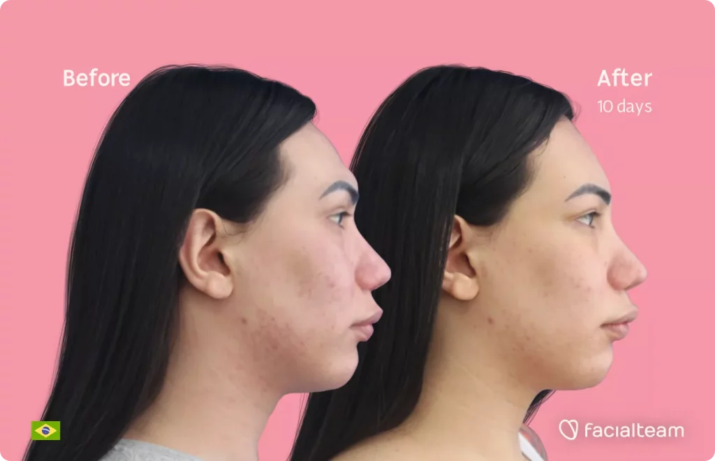 Side right image of FFS patient Gabrielly showing the results before and after facial feminization surgery with Facialteam consisting of forehead feminization.