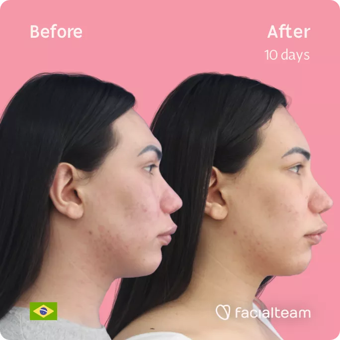 Square right side image of FFS patient Gabrielly showing the results before and after facial feminization surgery with Facialteam consisting of forehead feminization.