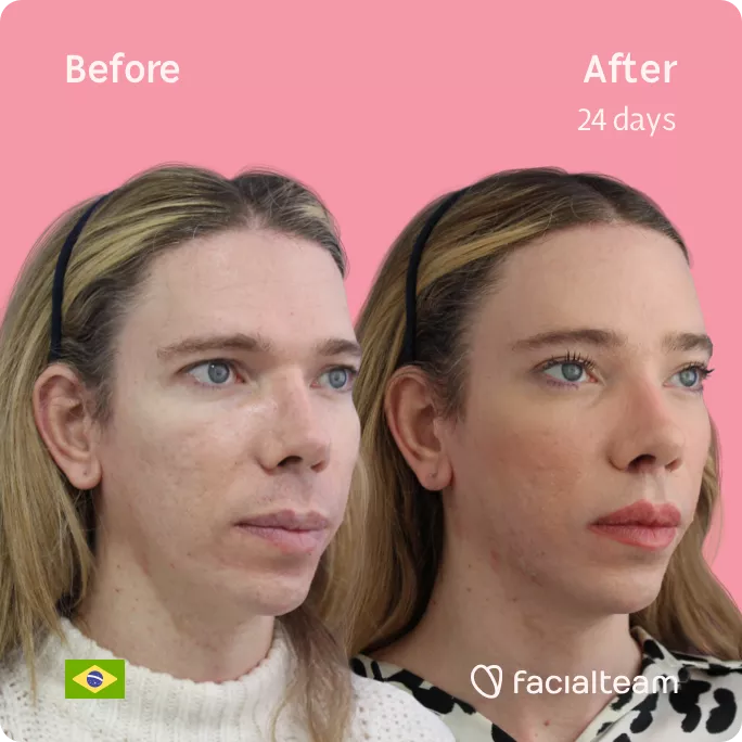 Square picture taken at a 45 degree right angle of FFS patient Sofia showing the results before and after facial feminization surgery with Facialteam consisting of forehead feminization.