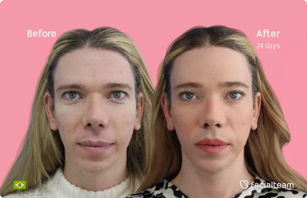 Frontal image of FFS patient Sofia showing the results before and after facial feminization surgery with Facialteam consisting of forehead feminization.