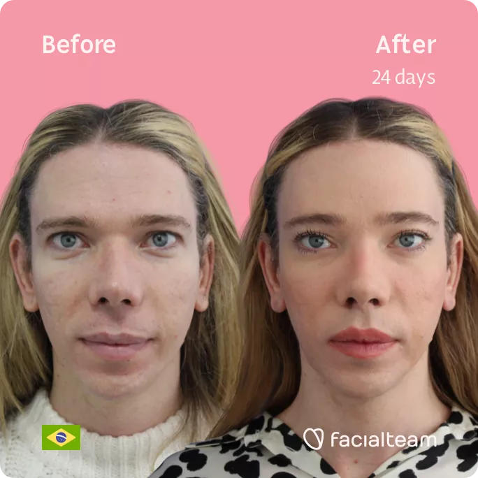 Square frontal image of FFS patient Sofia showing the results before and after facial feminization surgery with Facialteam consisting of forehead feminization.