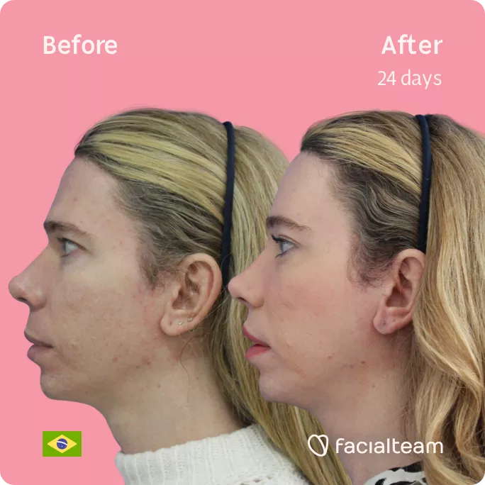 Square side image of FFS patient Sofia showing the results before and after facial feminization surgery with Facialteam consisting of forehead feminization.