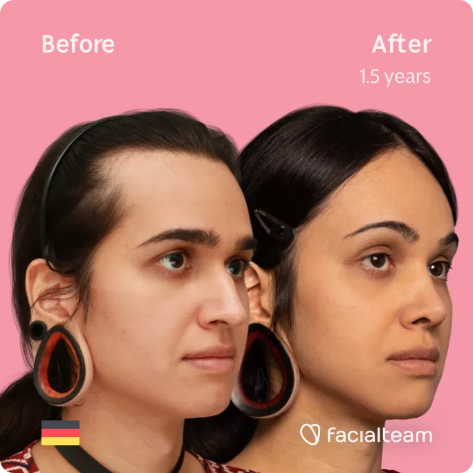 Square 45 degree right angle image of FFS patient Coco showing the results before and after facial feminization surgery with Facialteam consisting of forehead with SHT, rhinoplasty, jaw and chin feminization.