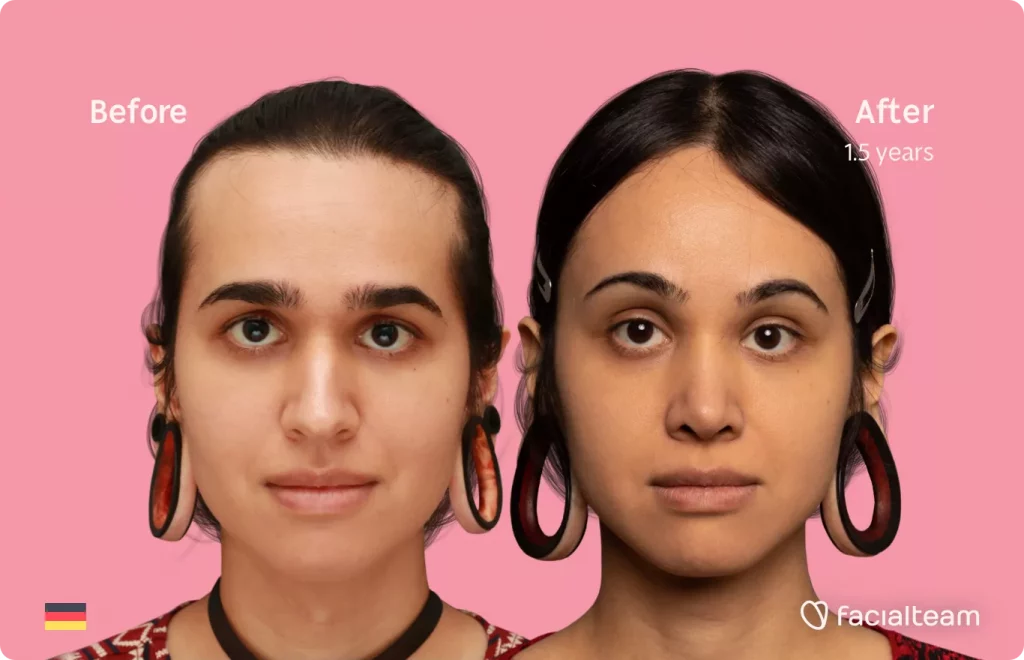 Frontal image of FFS patient Coco showing the results before and after facial feminization surgery with Facialteam consisting of forehead with SHT, rhinoplasty, jaw and chin feminization.