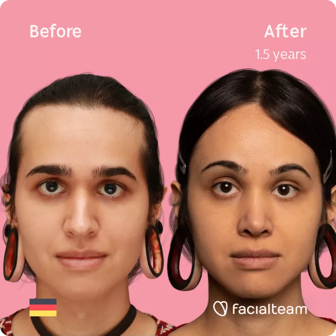 Square frontal image of FFS patient Coco showing the results before and after facial feminization surgery with Facialteam consisting of forehead with SHT, rhinoplasty, jaw and chin feminization.