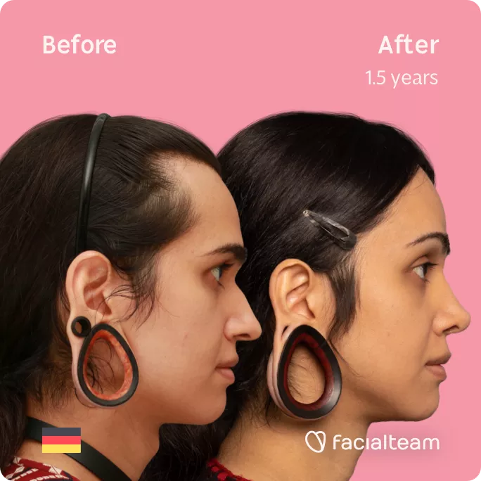 Square side image of FFS patient Coco showing the results before and after facial feminization surgery with Facialteam consisting of forehead with SHT, rhinoplasty, jaw and chin feminization.