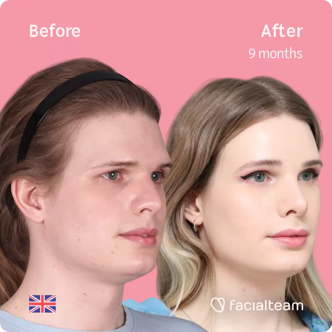 Square 45 degree angle image of FFS patient Jessie showing the results before and after facial feminization surgery with Facialteam consisting of forehead, rhinoplasty and tracheal shave feminization.