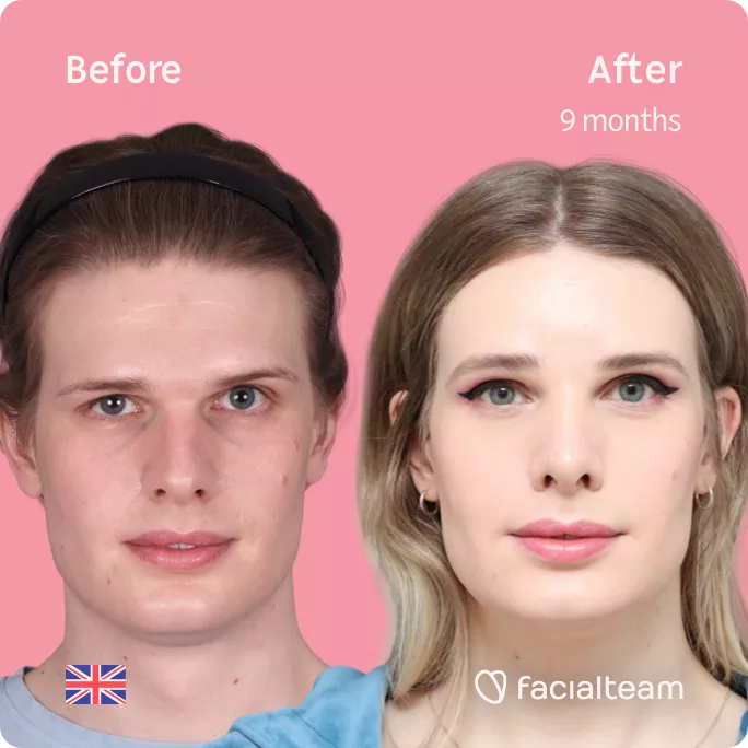 Square frontal image of FFS patient Jessie showing the results before and after facial feminization surgery with Facialteam consisting of forehead, rhinoplasty and tracheal shave feminization.