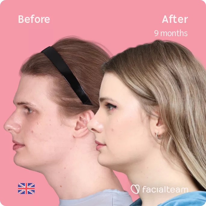 Square side left image of FFS patient Jessie showing the results before and after facial feminization surgery with Facialteam consisting of forehead, rhinoplasty and tracheal shave feminization.