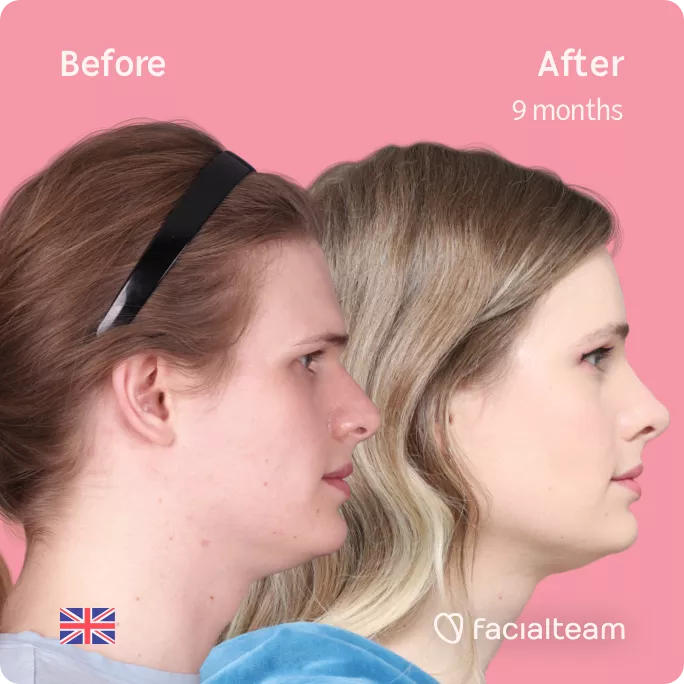 Square side right image of FFS patient Jessie showing the results before and after facial feminization surgery with Facialteam consisting of forehead, rhinoplasty and tracheal shave feminization.