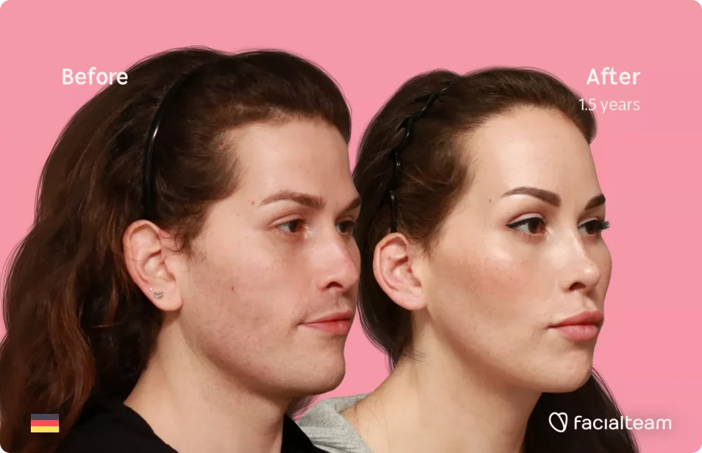 45 degree angle image of FFS patient Daniela showing the results before and after facial feminization surgery with Facialteam consisting of forehead feminization with SHT, rhinoplasty, tracheal shave, jaw and chin feminization.
