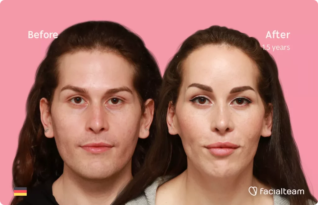 Frontal image of FFS patient Daniela showing the results before and after facial feminization surgery with Facialteam consisting of forehead feminization with SHT, rhinoplasty, tracheal shave, jaw and chin feminization.