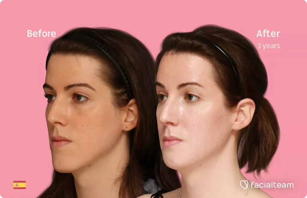 45 degree angle image of FFS patient Uma showing the results before and after facial feminization surgery with Facialteam consisting of forehead, jaw and chin feminization.