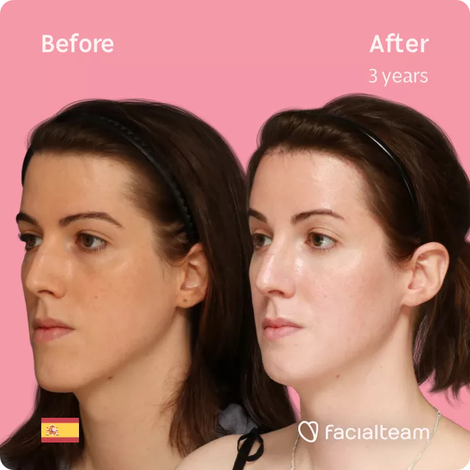 Square 45 degree angle image of FFS patient Uma showing the results before and after facial feminization surgery with Facialteam consisting of forehead, jaw and chin feminization.