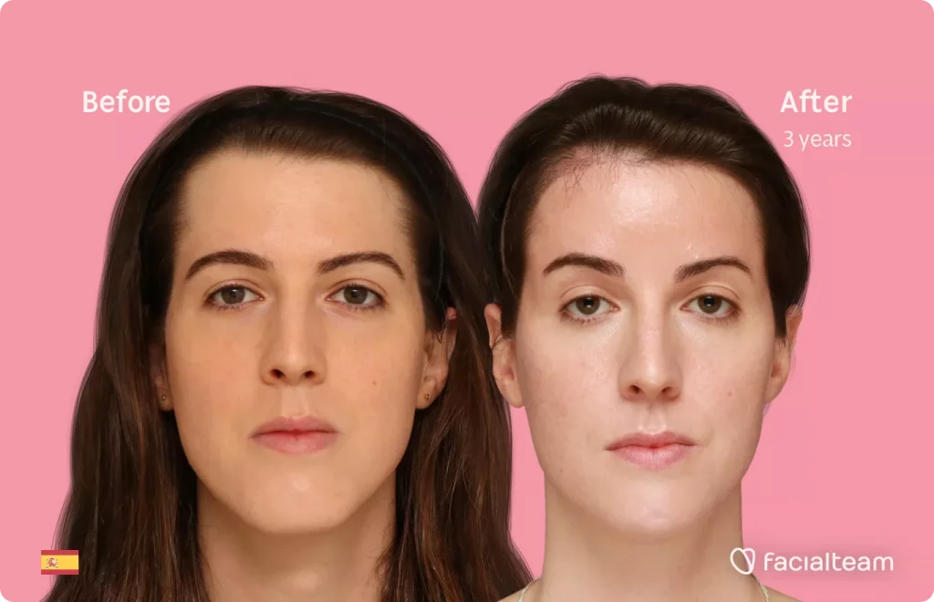 Frontal image of FFS patient Uma showing the results before and after facial feminization surgery with Facialteam consisting of forehead, jaw and chin feminization.