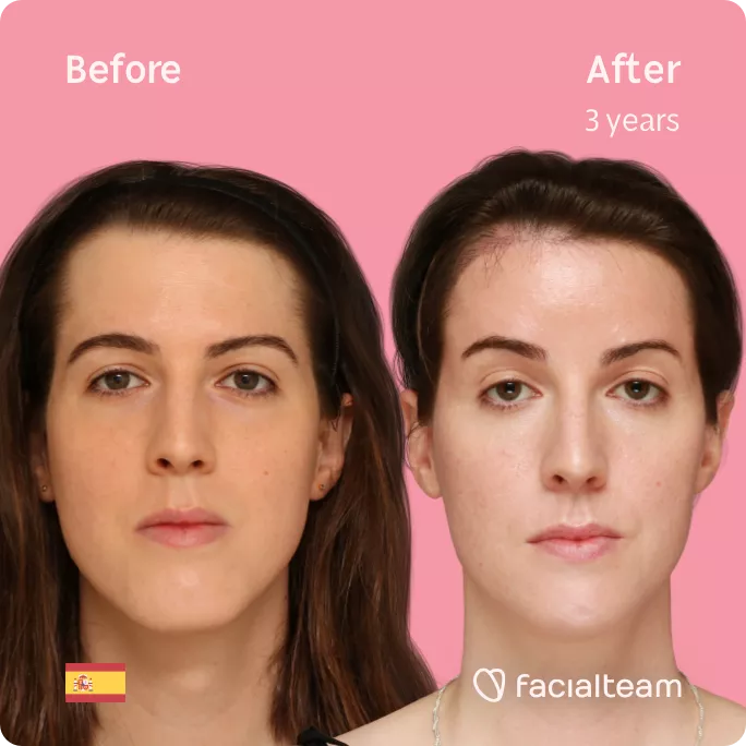 Square frontal image of FFS patient Uma showing the results before and after facial feminization surgery with Facialteam consisting of forehead, jaw and chin feminization.