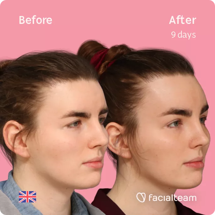 Square 45 degree angle image of FFS patient Eve showing the results before and after facial feminization surgery with Facialteam consisting of forehead feminization.