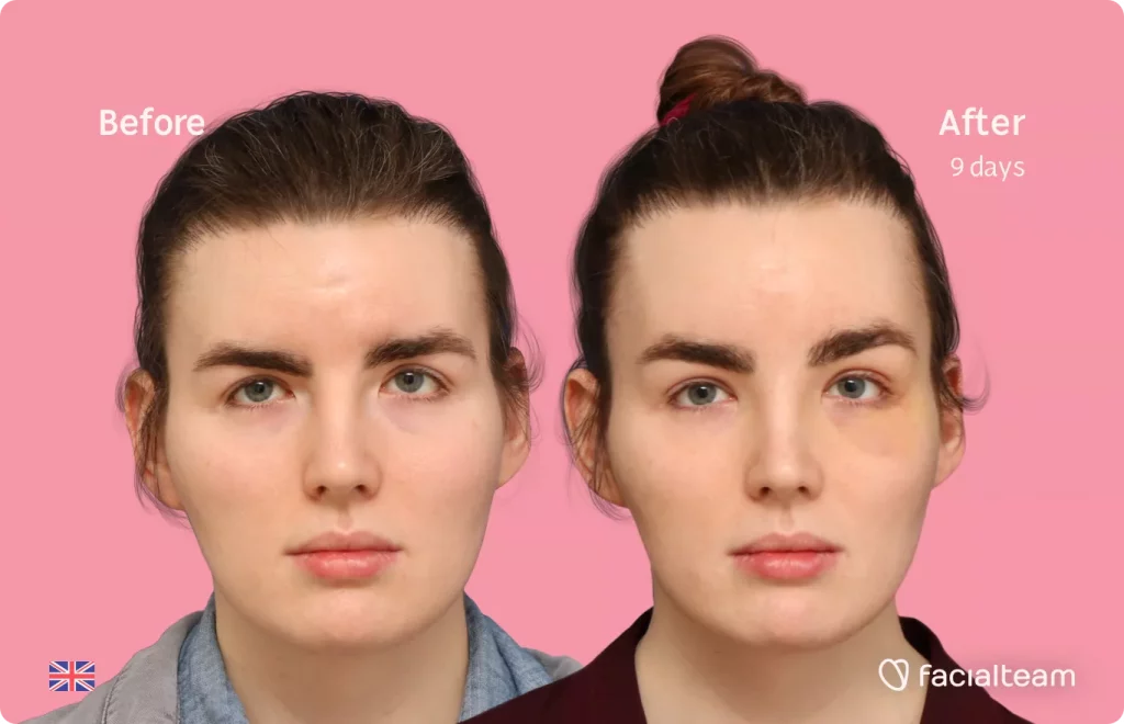 Frontal image of FFS patient Eve showing the results before and after facial feminization surgery with Facialteam consisting of forehead feminization.
