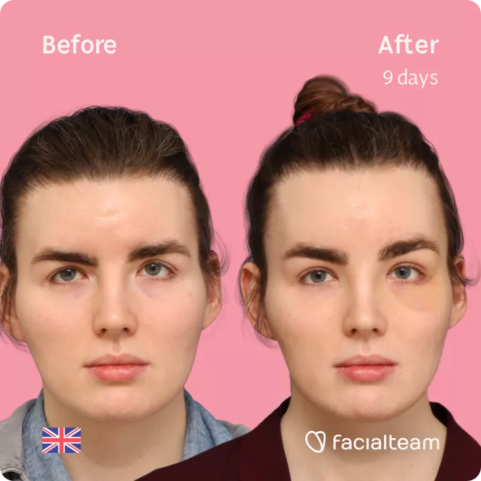 Square frontal image of FFS patient Eve showing the results before and after facial feminization surgery with Facialteam consisting of forehead feminization.